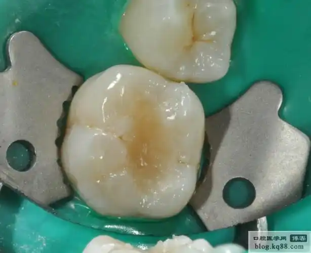 一例磨牙复合树脂修补病例