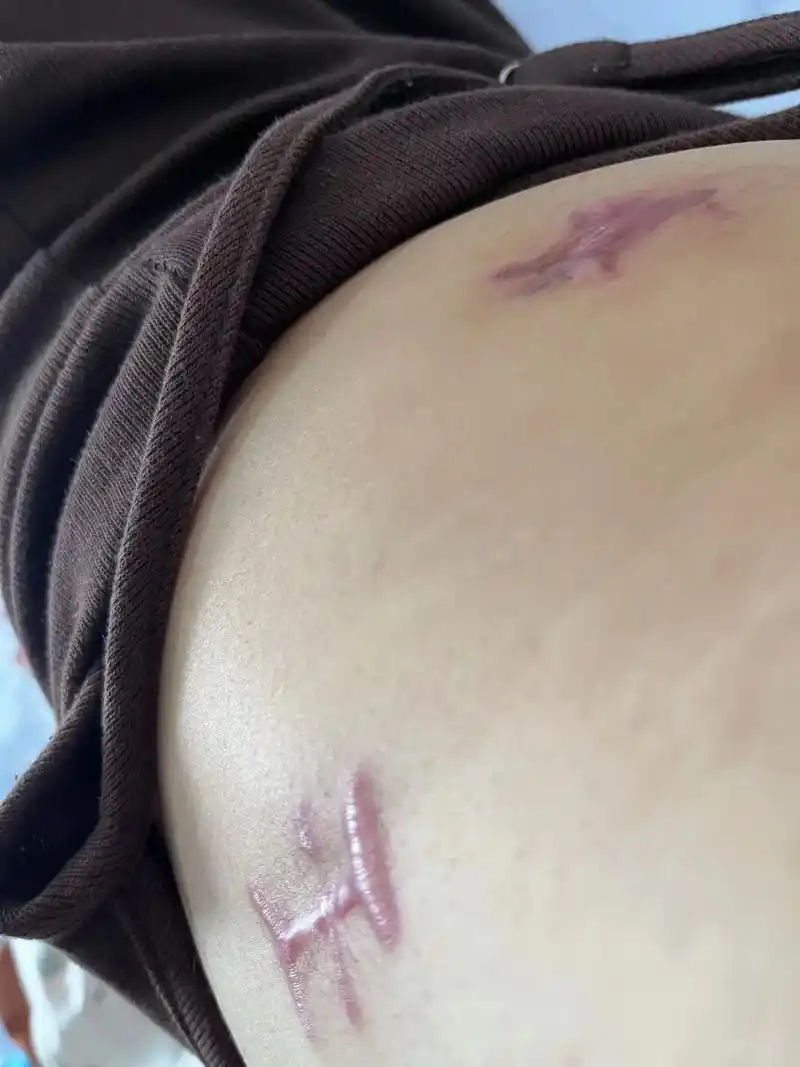 术后两月了.伤口最近反而疼起来了,觉得自己伤口恢复的很差,像 - 抖音