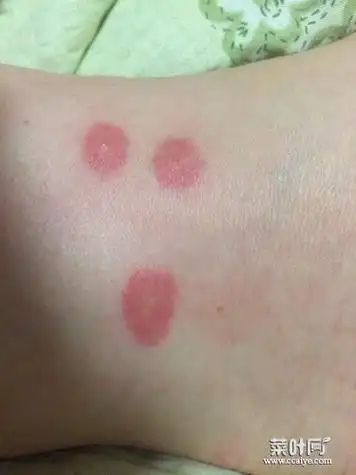 被不明虫子咬了红肿痒 虫子咬人伤口辨认图片