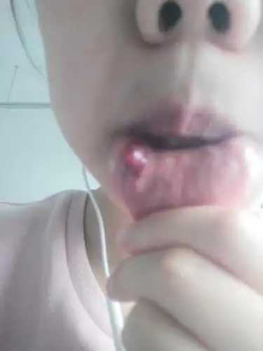 嘴里长了一个很大的包