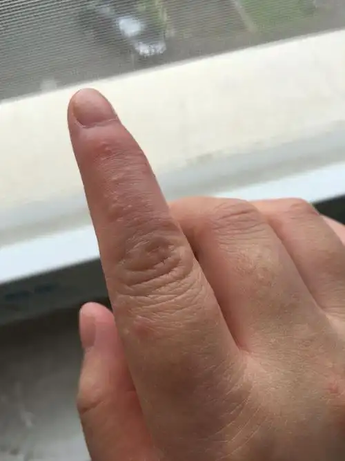 手上长了好多这样的类似水泡的东西 特别的痒 去药店拿了999 但没有用