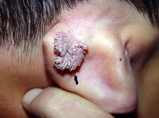 下面长菜花状疙瘩图片 菜花状图片-图片大观-奇异网