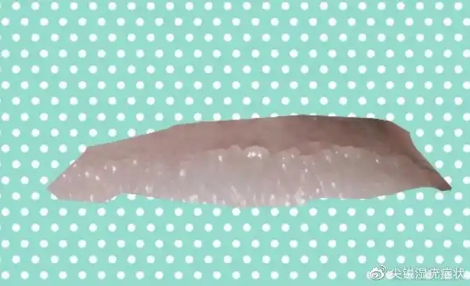 papillaris genitalis),又称为阴茎珍珠样丘疹病,冠状沟或龟头丘疹