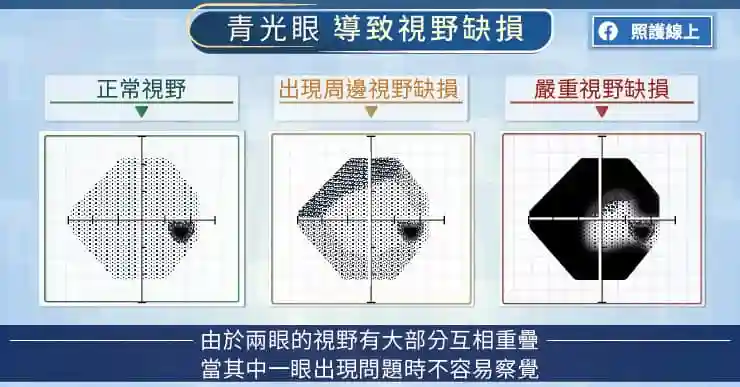 青光眼来袭,多数没自觉!正确诊断不只测眼压,眼科医师图文解说