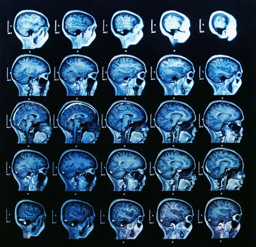 磁共振成像大脑扫描