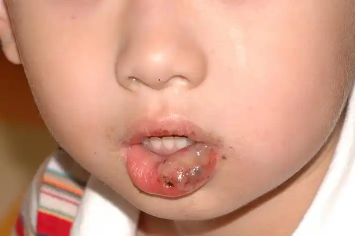 嘴唇被蟑螂咬了图片