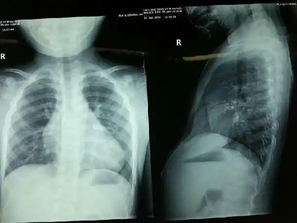 胸廓畸形:漏斗胸治疗病例展示_霍小森