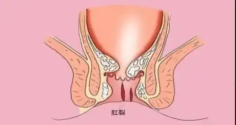 难忘……肛裂其实就是肛管皮肤全层纵行裂开并形成感染性溃疡的疾病
