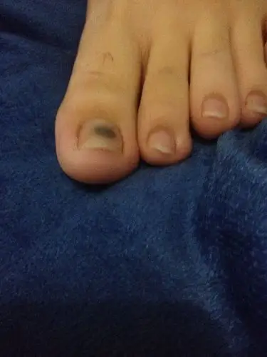 大拇指脚指甲出现黑色的东西,这是什么?