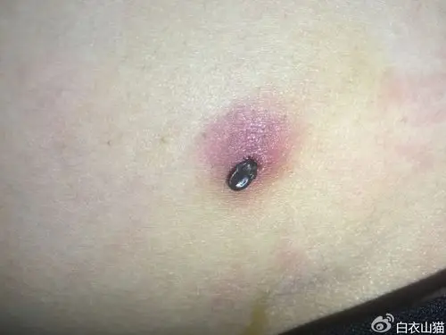 黑黑的就是吸血后的蜱虫,有半个手指甲盖那么大.