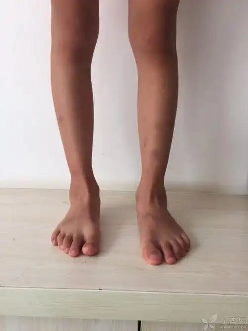 儿童踝关节外翻 - 骨科专业讨论版 -丁香园论坛