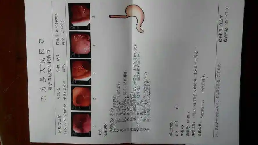 做过胃镜买保险不通过照过胃镜可以买保险吗