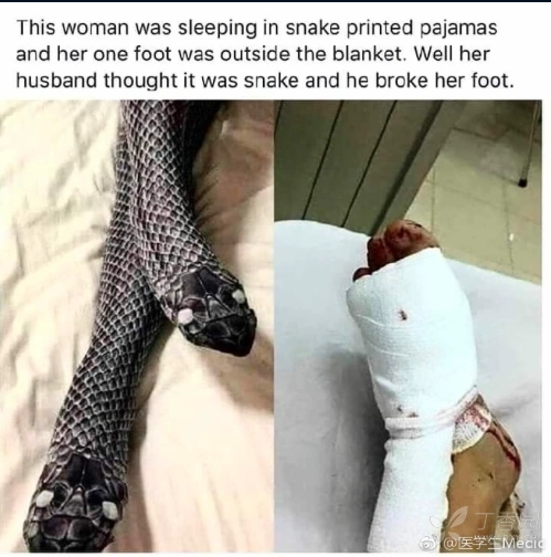 穿了个蛇纹袜,被丈夫误认为是蛇,然后……脚被砍伤了