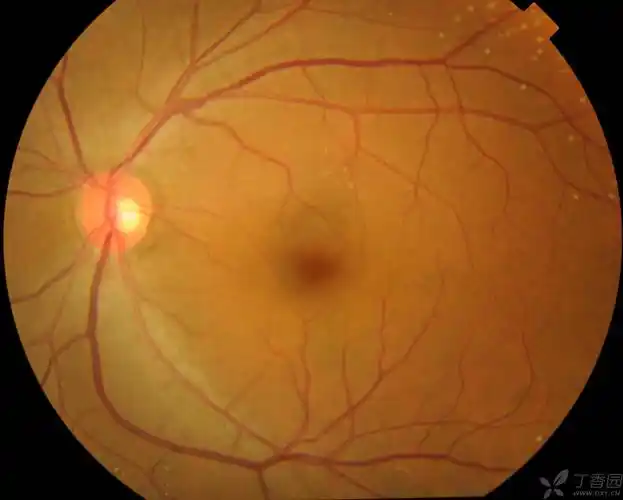 眼底白色斑点是一种具有特殊表现的遗传性脉络膜视网膜营养不良,该病