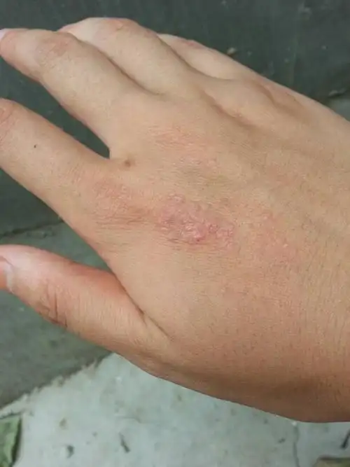 想问下手上长了半年多了,不摸它也不痒,挠的话会痒,这是什么?