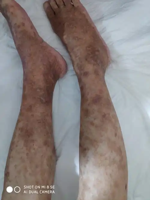 治愈青斑样血管病一例 - 好大夫在线