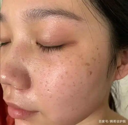 长斑总是苦恼的,本来无瑕的脸庞,让你每天满满自信,可突然冒出来的