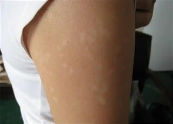 花斑癣手臂上的初期症状图片