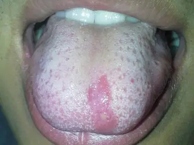 轻微舌癌图片 (36)_有来医生