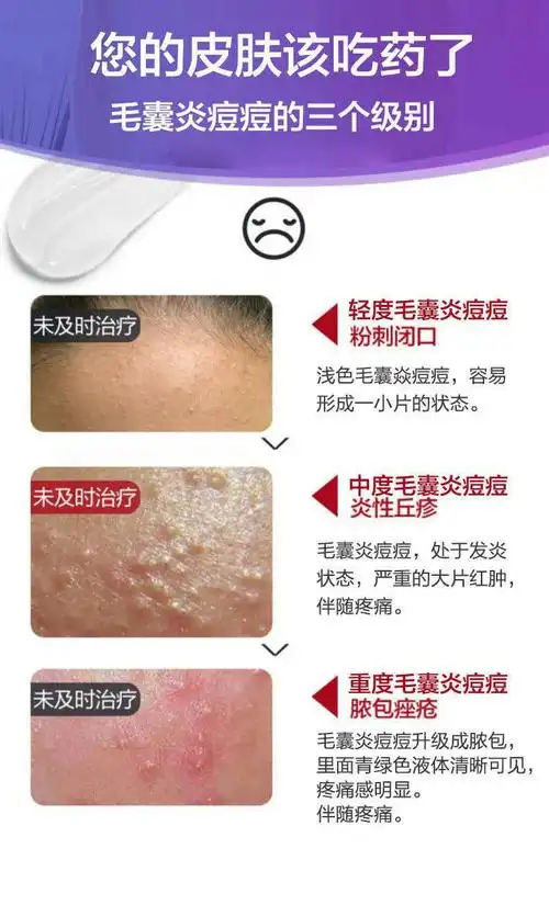 治毛囊炎马拉色菌胸前后背糠秕孢子菌毛囊炎膏薬草本萃取快速 黄色