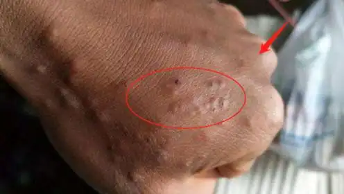 肺癌早期不疼不痒,一旦手上出现这情况,肺部必然有癌细胞!