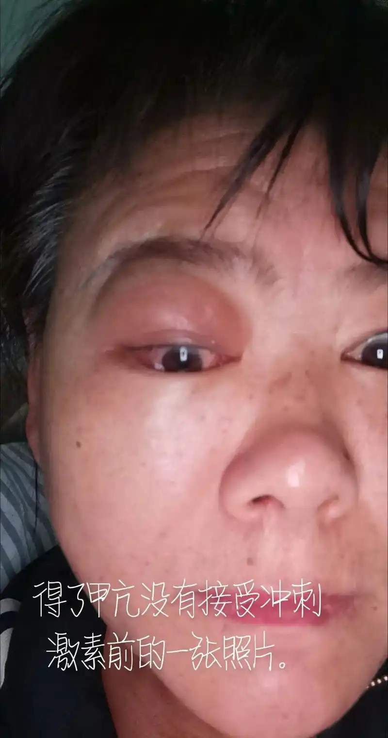 我做甲亢一年多了,开始没有这么严重,后来这半年多甲亢突眼