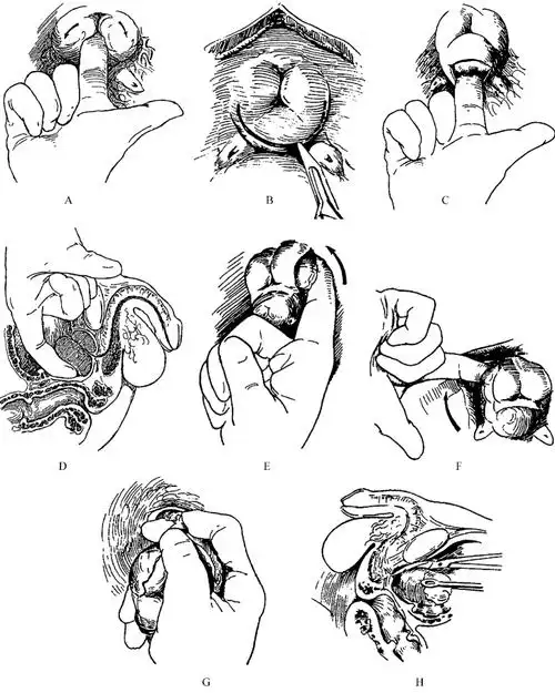 耻骨上经膀胱前列腺切除术