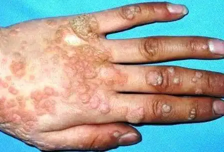 什么是菜花状疣图片,菜花状疣图片-图片大观-奇异网