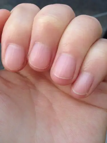 看指甲能看出什么问题吗!有竖愣是什么问题!