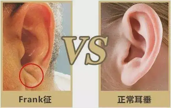 如果 心脏冠状动脉硬化愈严重,此折痕就愈趋明显.