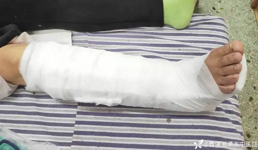 73岁的胫腓骨粉碎性骨折小夹板外固定一个月可以下地行走吗带完整固定