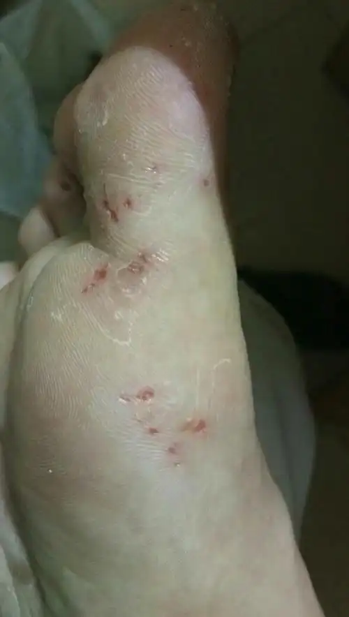 夏天脚上长水泡