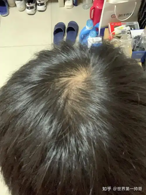 头顶头发稀少怎么办