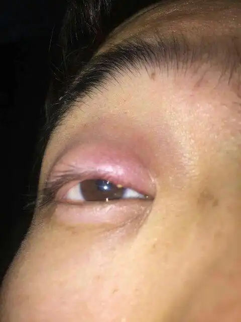 上眼皮肿疼是怎么回事,有什么办法快速消肿?