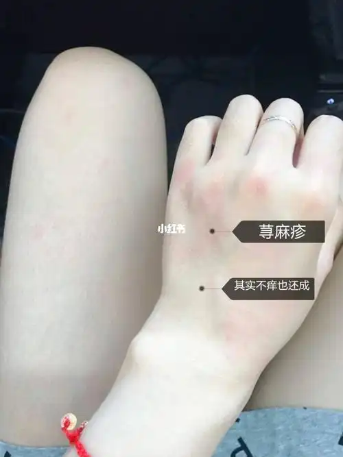 荨麻疹治疗新天地15天真的可以解决它