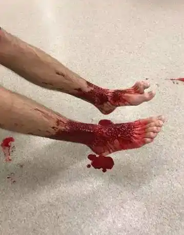 可怕墨尔本brighton海边满是这种东西它们吃人肉少年下了个海双腿变得