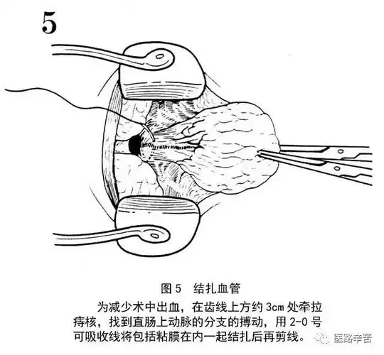 痔手术图解 | 混合痔外剥内扎术