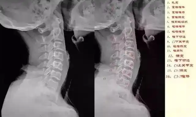 这样看颈椎x线,你也能成为高手!