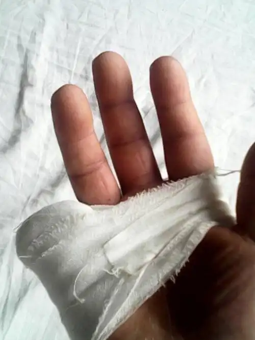 手指断了想再植医生有拒绝的权利吗