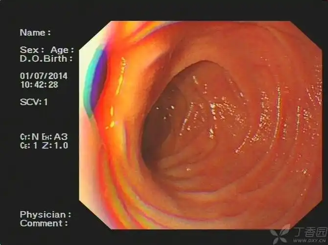 【原创】十二指肠水平部憩室一例