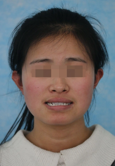 骨性反合---"地包天"如何治疗?