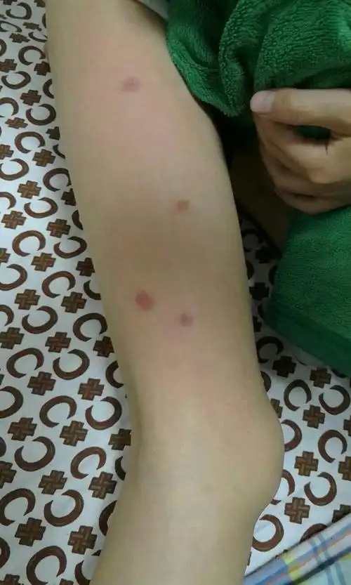 十岁孩子身上出现红斑,比较痒,都抓破了.