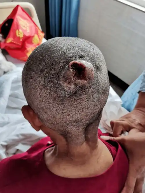 高龄老太终于可以洗头发记神经外科成功切除一患者头皮巨大肿瘤