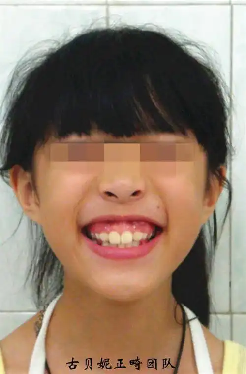 上颌前突露龈笑的改善—step 2—牙列拥挤患者术前术后微笑弧对比