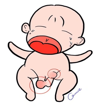 a:主要症状是反复出现腹股沟或者阴囊的实性包块,常见于儿童哭闹或