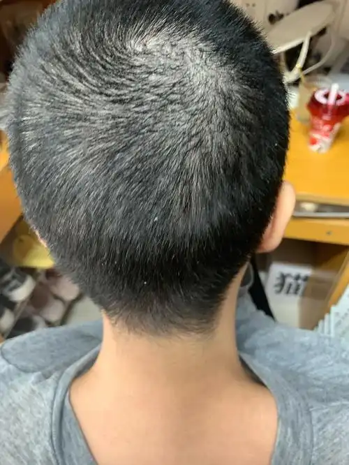 但是不知道是不是因为喷的药的原因长头皮屑,#秃头  #剃头  #长头发