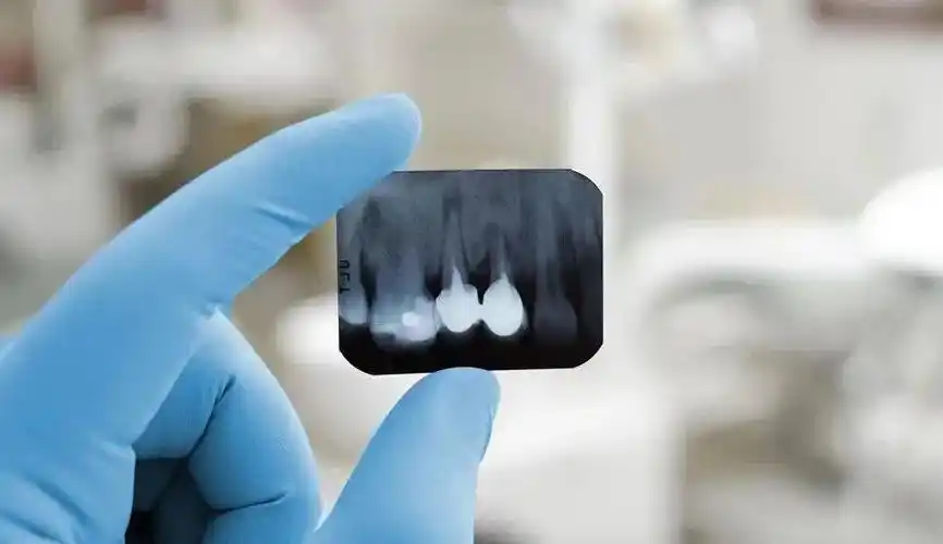 牙片是口腔科应用最广的检查手段,也是最常用的,因为它在牙的治疗前