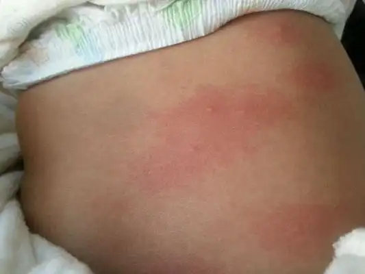 季节性荨麻疹47