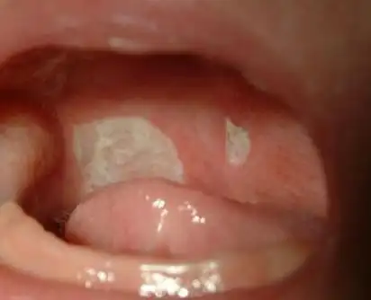 婴儿口腔溃疡什么原因婴儿口腔溃疡是什么原因