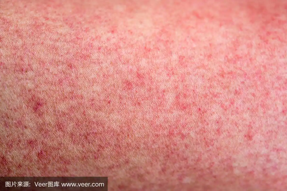 皮肤有登革热红疹